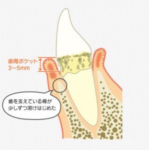 periodontal_pocket_cnt2_img